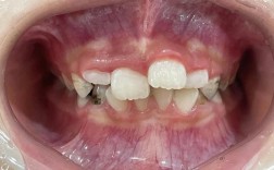 牙齿矫正中途停止