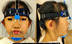 口腔正畸牵引装置视频演示了什么操作？