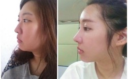 牙齿矫正可以改变鼻子