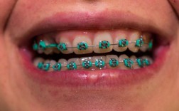 正畸牙缝变大、磨牙不止，原因和对策是什么？