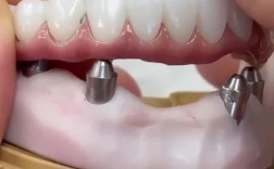 种牙手术后旁边牙活动，是何原因？