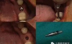 种植印模的方法有哪些关键操作步骤和注意事项？