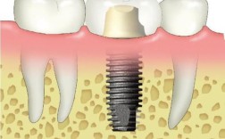 即拔即种牙一颗价格是多少？