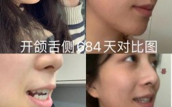 开颌 正畸 案例