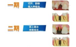 想做种植牙却不知如何选？医院资质、医生技术、服务体验哪个更重要？这些关键点帮你判断哪里靠谱！