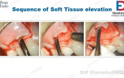 翻瓣手术缝合常用方法有哪些？