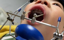 反颌正畸3D视频