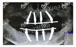 all-on-4植牙图包含哪些种植流程、技术要点及效果信息？