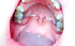 牙齿矫正正畸过程图片