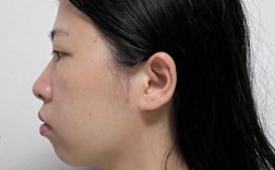 正颌后为何必须正畸？不做的后果是什么？