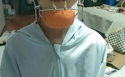 地包天 正畸 深圳