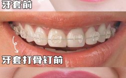 钢丝粗细如何影响牙齿矫正效果？