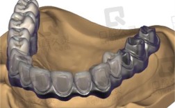 种牙桥架的应用