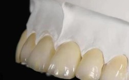 德国种牙品牌怎么选？不同技术、口碑和性价比的牌子哪个更适合你的口腔需求？