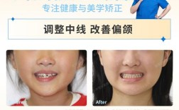 牙齿轻度拥挤矫正一般需要多长时间？