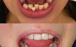 沈阳牙齿矫正隐形