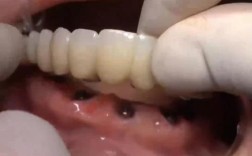 半颗门牙种牙，具体流程和注意事项有哪些？