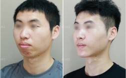 正畸跟着正颚外科一起