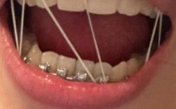 拔虎牙能种牙吗