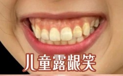 正畸整成露龈笑