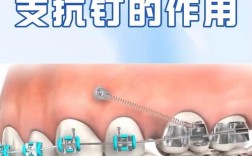 正畸种植支抗钉型号