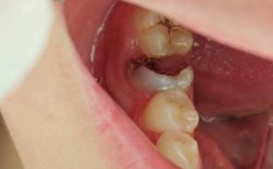 正畸 牙釉质损伤