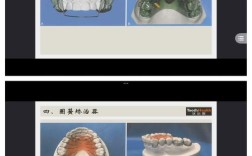 正畸模型制作的关键步骤与注意事项有哪些？