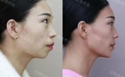 正畸手术和正颌手术，两者有何不同？