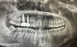 种牙前拍X光检查，辐射对身体有影响吗？会影响种牙效果和后期使用吗？