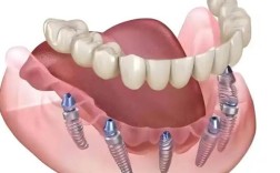 半口即刻种植牙种几颗最合适？