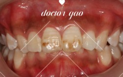 氟斑牙修复方法图解