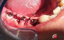 上牙即拔即种效果如何？安全性和适用人群有哪些？