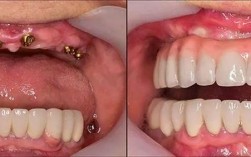 欧美vs韩国种牙，该怎么选？