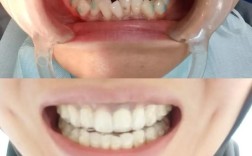 牙齿美白和矫正，该先做哪个更有效？