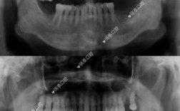 种牙会影响CT检查结果准确性吗？CT成像又是否会对种牙方案制定产生干扰？