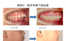 正畸侧切牙小咬合错位