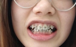 正畸金属自锁最后面钢丝有何关键作用？