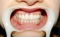 牙周炎治疗后正畸