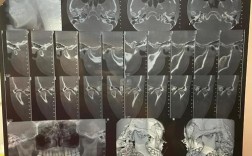 髁突吸收怎么做正畸