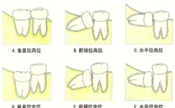 阻生智齿分牙有哪些常用方法？不同阻生类型如何选择最佳分牙方式？效果与术后恢复有何差异？