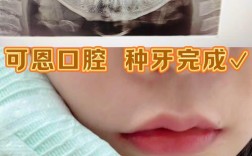 上颌牙种牙很难吗