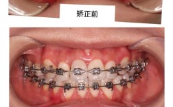 齿鄂矫正和牙齿矫正