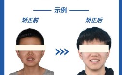 牙齿非常乱，矫正真的能变整齐吗？效果好不好？要多久？