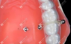 正畸牙钉是什么材质