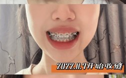 牙齿正畸=带牙套吗