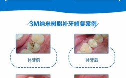 树脂种牙是否需要磨牙？