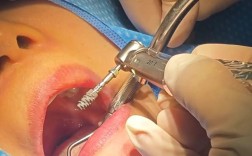 山西大口腔种牙