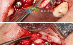 正畸螺钉植入术前，患者需做好哪些关键准备与注意事项？