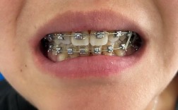 拔了四个牙，为何最终放弃正畸？