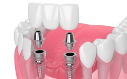 昆山弔博士种牙好不好？效果靠谱吗？